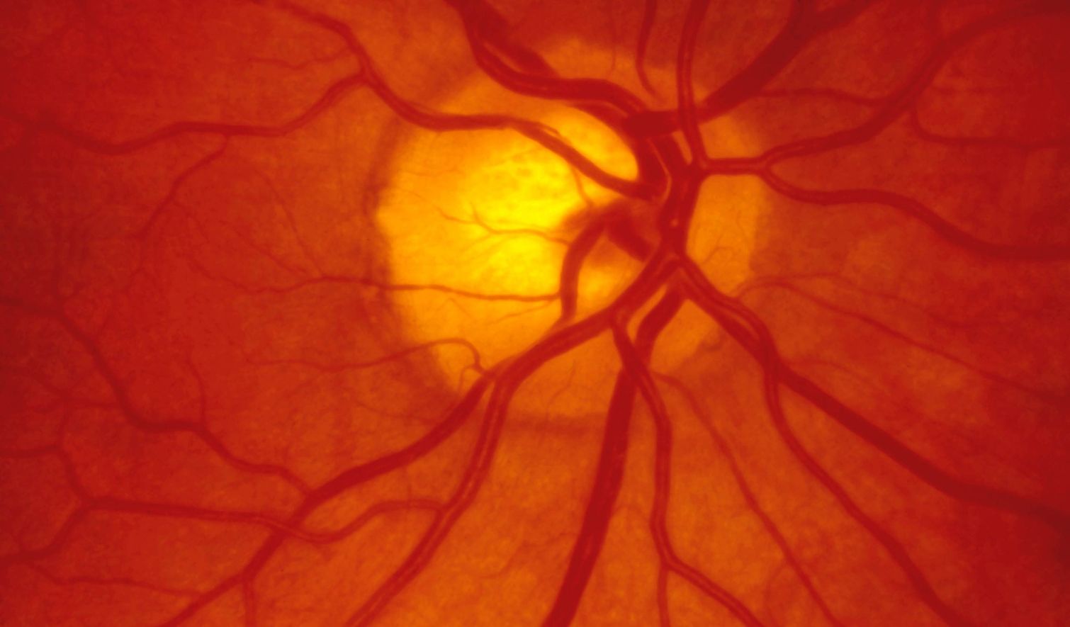 Παθήσεις Αμφιβληστροειδούς / Ωχρά Κηλίδα